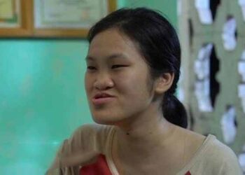 9X Phú Thọ 'như được hồi sinh' sau 3 ca đại phẫu gương mặt