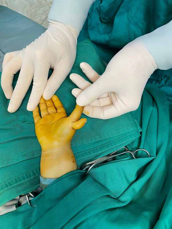 Phẫu thuật trả lại bàn tay cho bé 23 tháng mắc dị tật thừa ngón