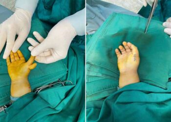 Phẫu thuật trả lại bàn tay cho bé 23 tháng mắc dị tật thừa ngón