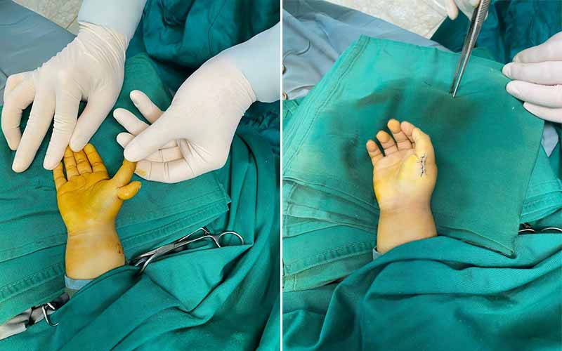 Bệnh viện đa khoa tỉnh Phú Thọ sử dụng Robot phẫu thuật cột sống