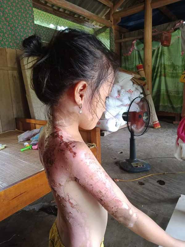 Phú Thọ: Công an 'vào cuộc' vụ bé gái bị hàng xóm dội cả ấm nước sôi vào người