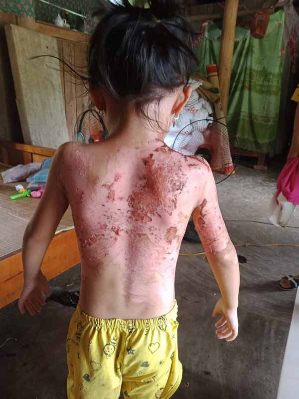 Phú Thọ: Công an 'vào cuộc' vụ bé gái bị hàng xóm dội cả ấm nước sôi vào người
