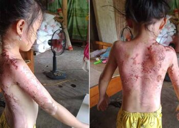 Phú Thọ: Công an 'vào cuộc' vụ bé gái bị hàng xóm dội cả ấm nước sôi vào người